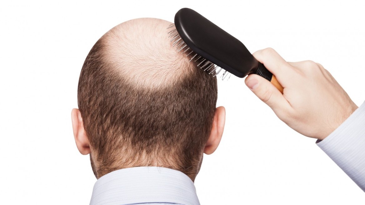 shutterstock_bald-1168x657